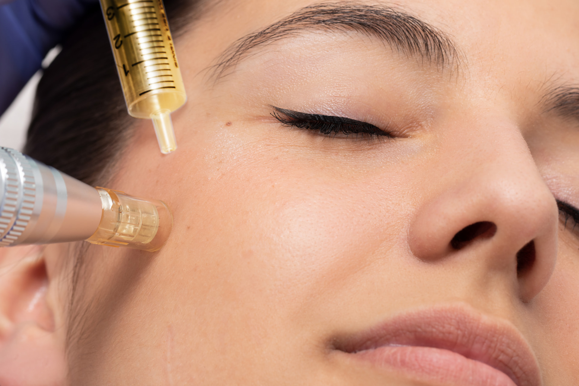 Mesotherapie mit Wiotech und Wirkstoffserum an der Gesichtshaut